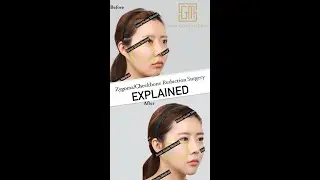 Zygoma/Cheekbone Reduction Surgery | Seoul Guide Medical #Zygomareduction #Cheekbonereduction