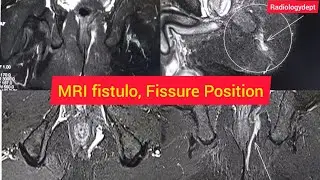 Mri fistulagram Check Possition in Hindi | #Fistulagram @Radiology Dept   How to check #mriFissure