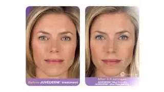 Restore Volume in the Face with Soft Tissue Fillers