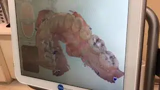 iTero element (アイテロ　エレメント) スキャンの様子　インビザライン　アートデンタル中田南クリニック
