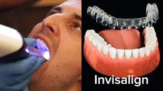 Invisalign, sure smile ,clear aligner