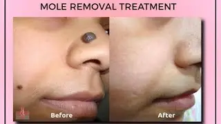 Til | Frackles | Mole Removal | Kayakalp Laser Clinic Muktsar
