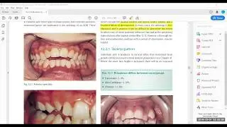 Open Bite from laura micheal