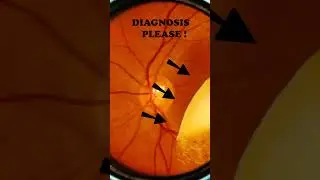 Diabetic retinopathy | Vitreous | Hard exudates | Fundus | Short Video 192