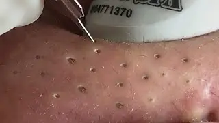 徹底的な鼻の黒ずみ除去｜毛穴の奥深くまでしっかり洗浄