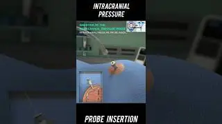Intracranial pressure (ICP)  probe Insertion #3D Animation/// #Anatomy