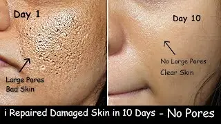 Niacinamide Serum to Close Large OPEN PORES - Aloevera ice cubes for Skin Tightening