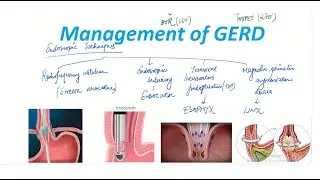 Management of Gerd | General Surgery Lecture | MBBS / MS/ DNB |