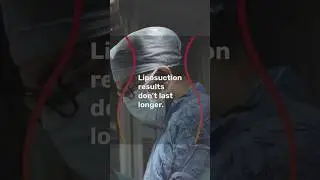 Liposuction Transformation: 1-Year Results with Mumbai's Top Surgeon | #shorts #liposuction