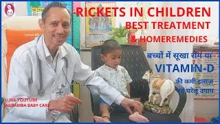 RICKETS IN CHILDREN BEST TREATMENT & HOMEREMEDIES,बच्चों में सूखा रोग VITAMIN -D की कमी इलाज़ नुस्खे