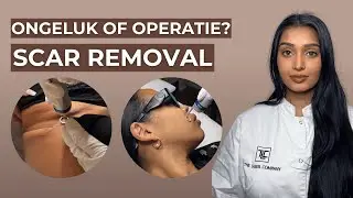 Scar Removal Getinte Huid | PicoWay Laser | Litteken verwijderen | Amsterdam | The Laser Company