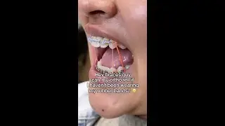 Могут ли ортодонты определить, лжёте ли вы о ношении резинок? 😅