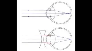 Refractive Errors - Hyperopia, Myopia, Astigmatism, Accommodation & Presbyopia