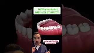 INLAYCORE (pivot) ou IMPLANT dentaire : la diff&eacute;rence ?