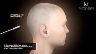 FUE Animation- The Maitland Clinic