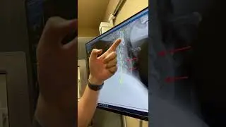 Is degeneration of the spine normal?