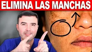 Con SOLO 1 USO ELIMINAR&Aacute;S las MANCHAS de la PIEL y MARCAS del ACN&Eacute;  Remedio Casero Manchas Oscuras