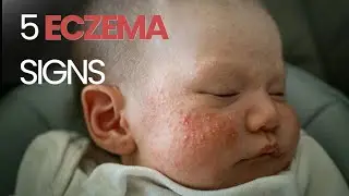 Did I Miss These 5 Baby Eczema Infection Signs?
