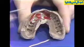 Electroformed Die Technique for Rubber Base Impressions