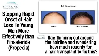 Stopping Rapid Hair Loss in Young Men with a Better Treatment than Finasteride or Transplants
