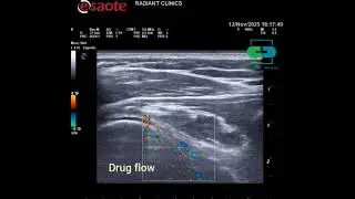ultrasound guided shoulder joint hydrodilataion for adhesive capsulitis