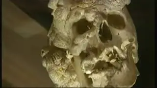 Joseph 'John' Merrick - let him rest in peace (UK) - BBC London News - 9th June 2016