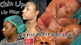 VLOG: My Ethnic Rhinoplasty| Chin Lipo| Lip Filler| Dr Umit Taskin| Istanbul, Turkey 🇹🇷