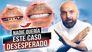 El caso dental más difícil: de dientes terribles a una sonrisa perfecta. Antes y después