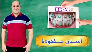تقويم أستثنائي | كيفية تقويم الأسنان في حاله أسنان مفقوده؟ #دكتور_اسلام_نبيل