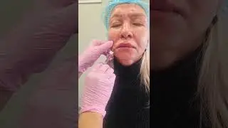 Заполнение носогубных складок.Аспирационная проба👌