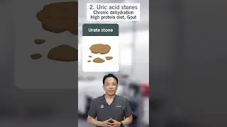 4 Types of Kidney Stones You Should Know