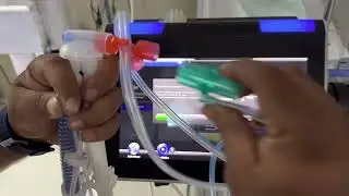 Bella Vista Ventilator with Neonatal Calibration @durgaprasadmamidi9090