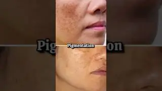 Say Goodbye to Dark Spots | The Derma Co 2% Kojic Acid Serum Review