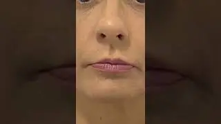 Dra. Nathalia Bernardo , caso sensacional de harmoniza&ccedil;&atilde;o facial!