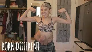 I’m Finally Ready To Show The World My Tumours | BORN DIFFERENT