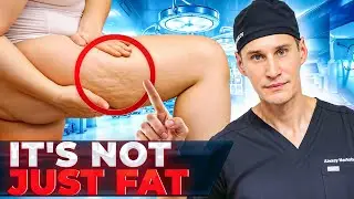 10 Must-Know Facts About Lipedema
