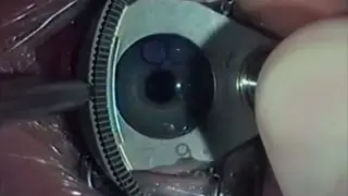 Augenlaseroperation | Nie wieder Brille oder Kontaktlinsen