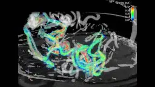 Intra cranial 4D flow MRI   Complex 3D blood flow dynamics in a large AVM tlWfZys YOU