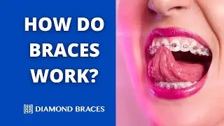 How Do Braces Work?