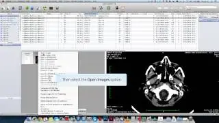 How to Use OsiriX