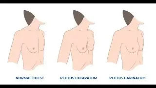 Chest deformities Pectus Carinatum or Pectus Excavatum (Pigeon Chest and Funnel Chest)