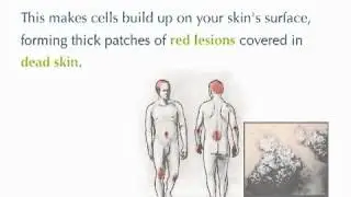 Revitol Dermasis Psoriasis Cream [3 MONTHS FREE SUPPLY] Best dermasis