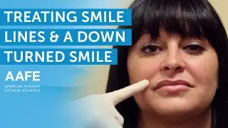 Treating Smile Lines and a Downturned Smile | AAFE