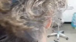 Hair Doctor  Near Hydes, MD  | Transplant Before and After Video