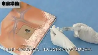 トレフューザーポンプ投与終了時 ヒューバー針 抜針説明
