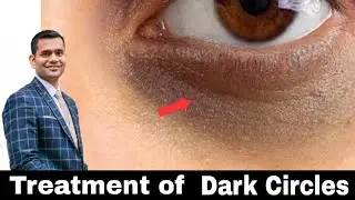 How To Get Rid Of Dark Circles Naturally | Dr.Vivek Joshi