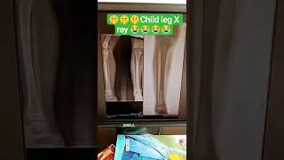 Child leg x -Ray l child 🚸  l  medical diagnostic X ray child#kidscare #kidsdoctor #childhealthcare