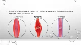 Tendinopathy Rehabilitation ||Tendonitis|| Tendinopathy ||Tendinosis||Tenosynovitis||Load management