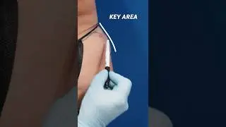 Liposuction in the KEY AREA