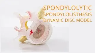 Spondylolytic Spondylolisthesis Dynamic Disc Model